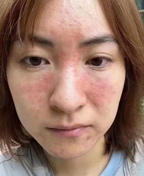 激素脸是什么症状