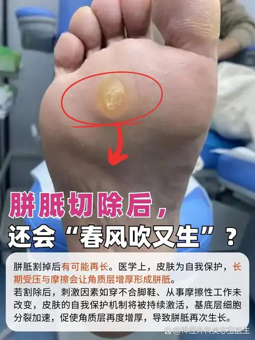 角质厚是什么原因