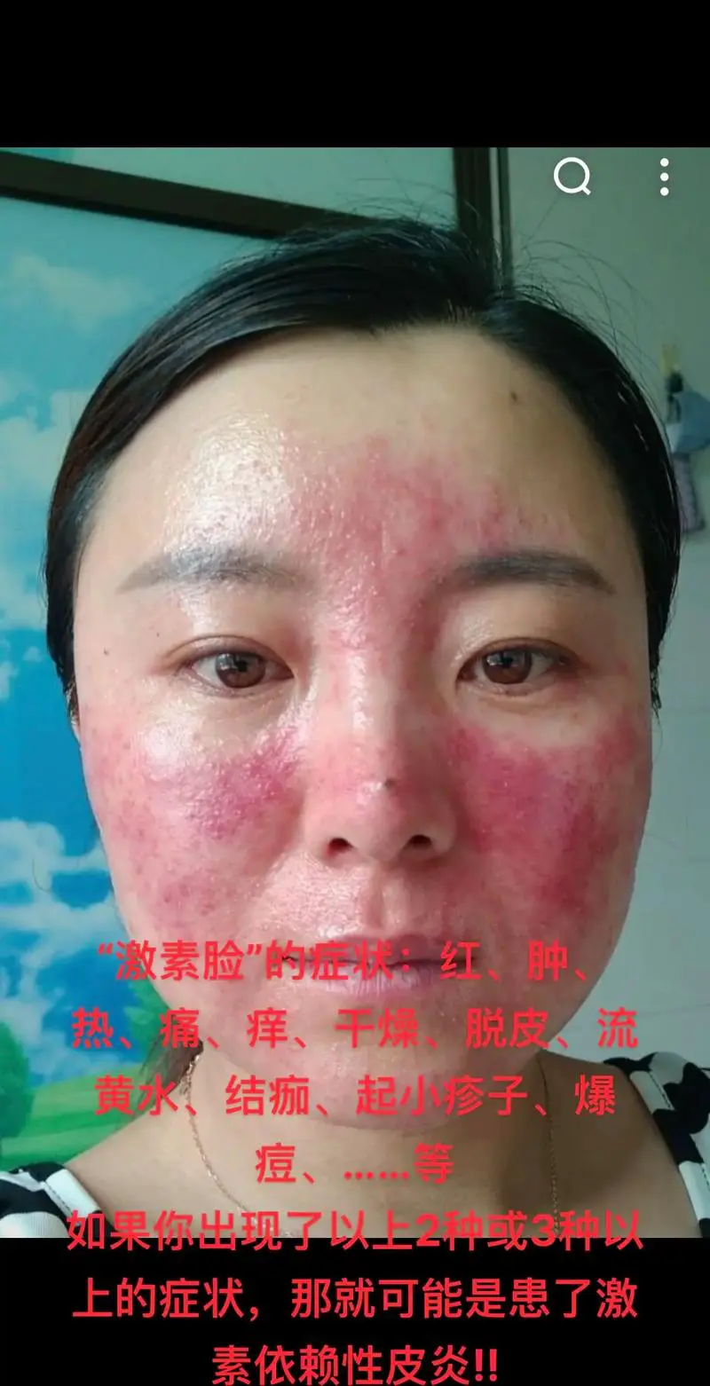 激素脸是什么症状