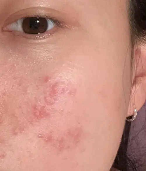 护肤品过敏什么症状