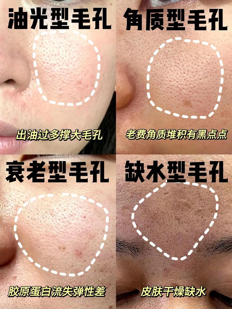 毛孔突然变粗大?春季护肤该如何应对?