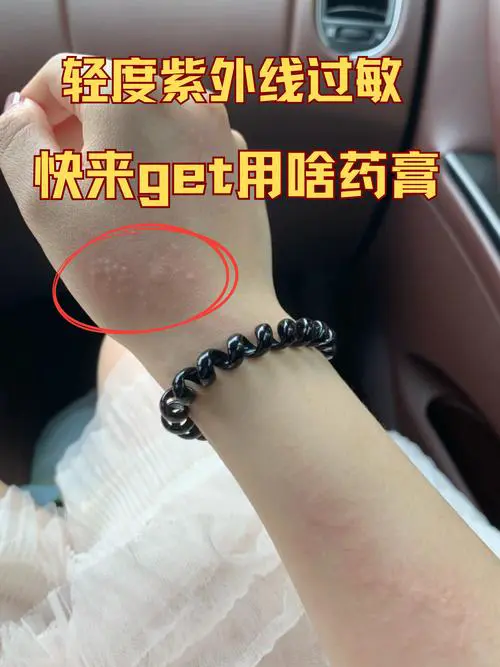 过敏皮肤涂什么