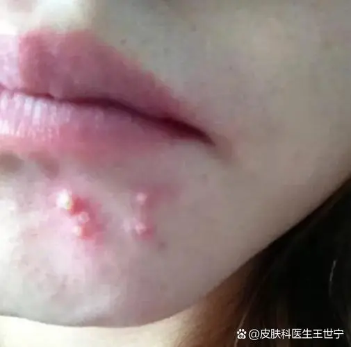 为什么来月经会长痘