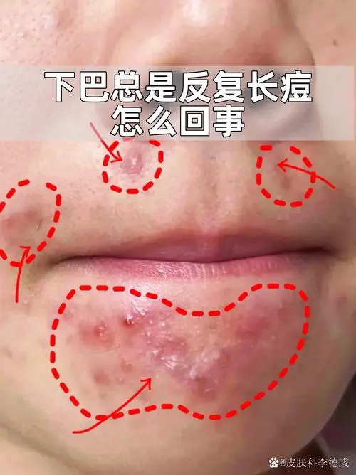 下巴长痘代表什么