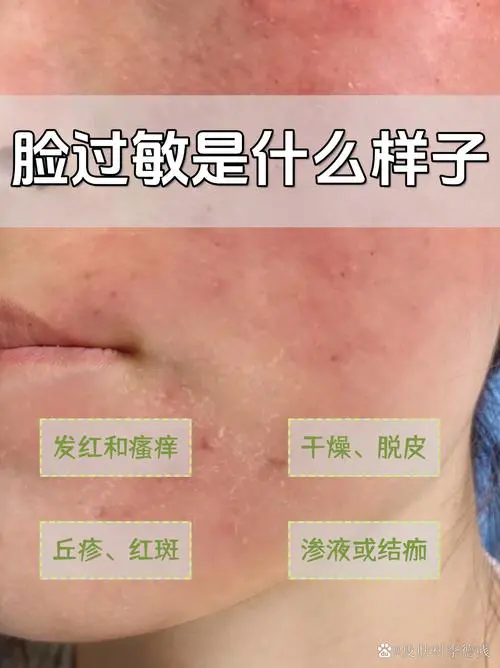 脸为什么经常过敏