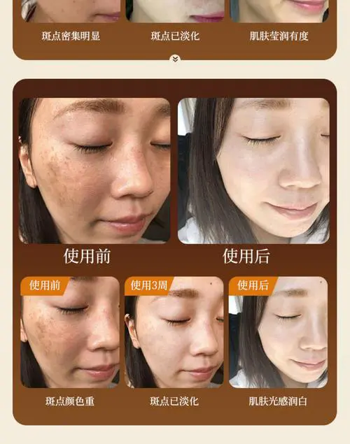 黄褐斑用什么护肤品