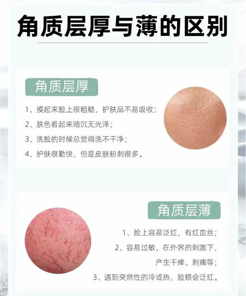 什么是角质层薄