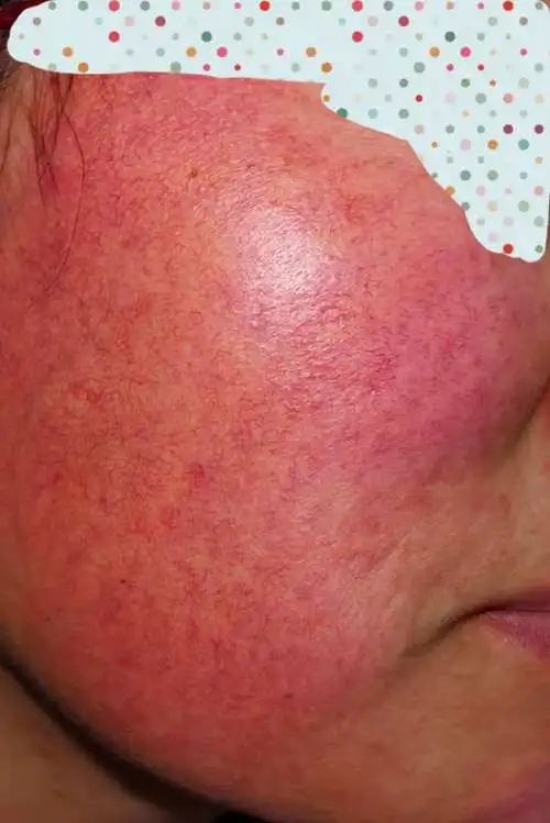 激素脸是什么症状