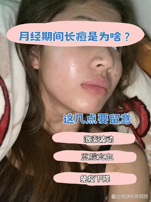 为什么来月经会长痘