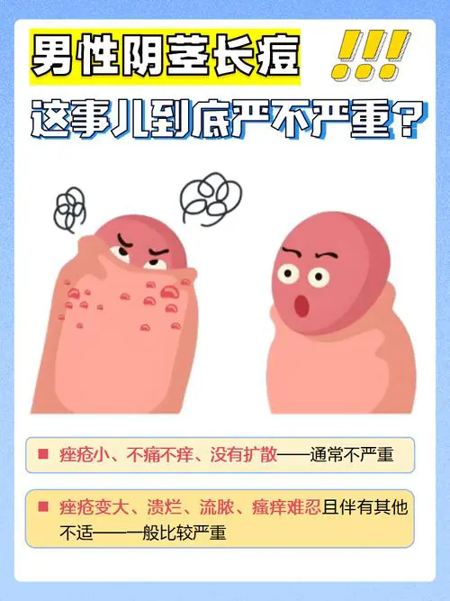 男的长痘痘什么原因