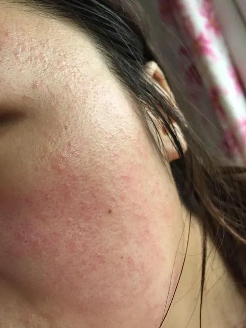 护肤品过敏什么症状