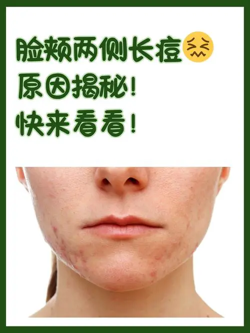 两颊长痘痘是什么原因