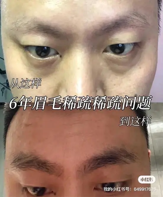 眉毛为什么越来越少