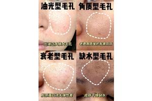 毛孔突然变粗大？春季护肤该如何应对？