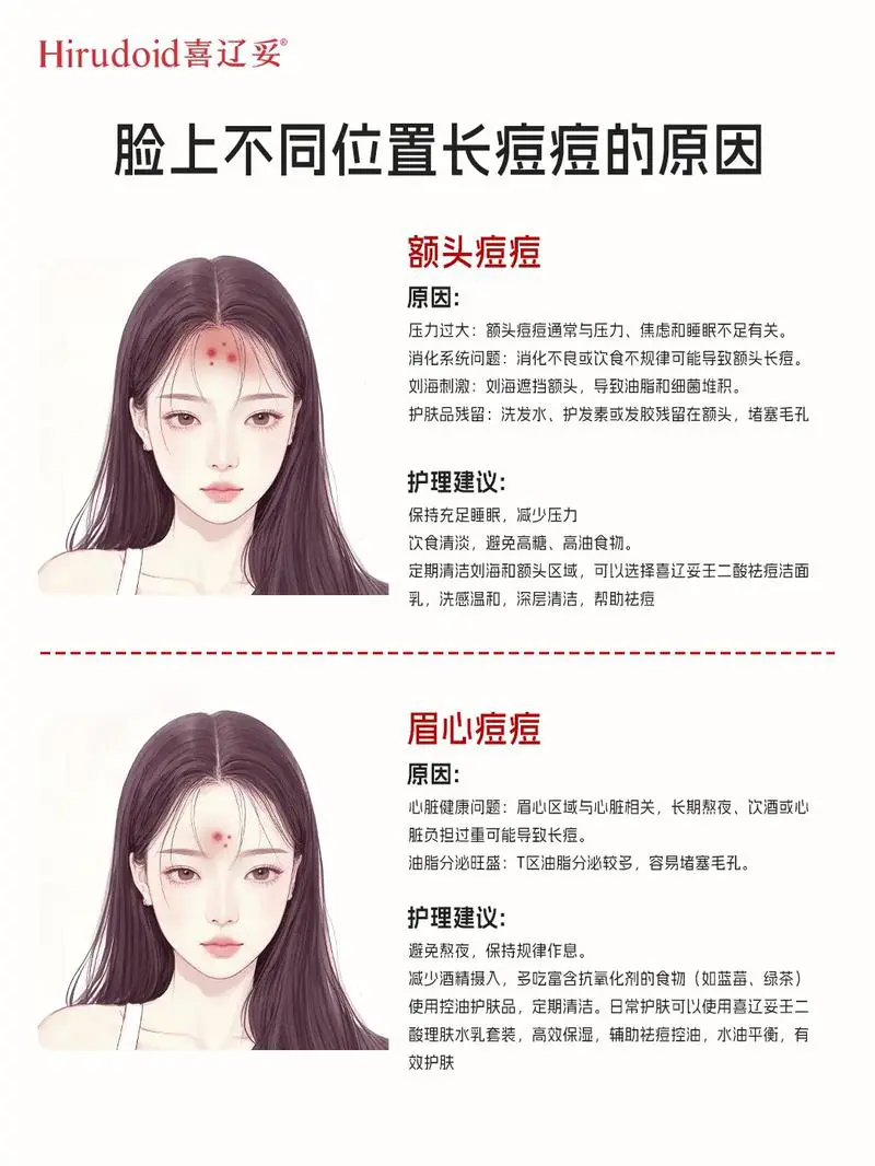 脸上为什么老长痘痘