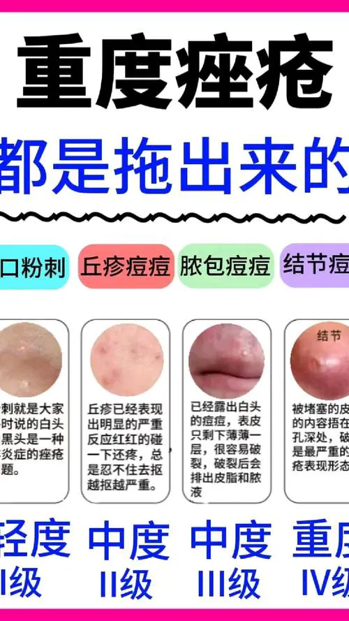 长期长痘痘是什么原因