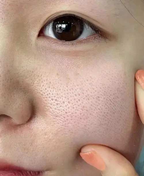 为什么毛孔越来越大