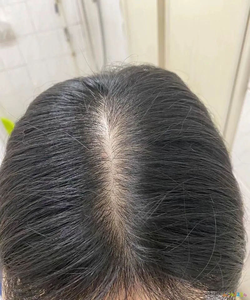 脱发做有氧运动_有氧运动 脱发_脱发无氧运动