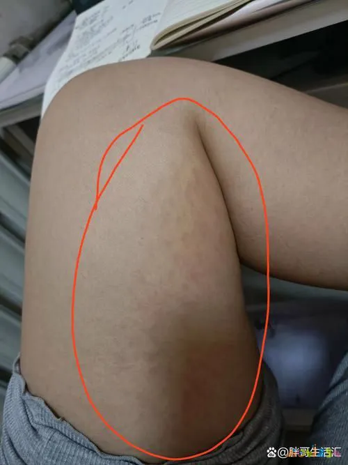 大腿脂肪消耗运动能减肥吗_怎样运动消耗大腿脂肪_大腿脂肪消耗运动能量吗