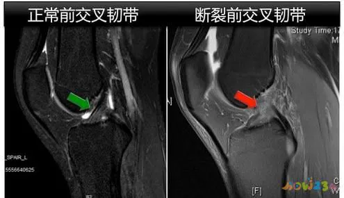 运动的膝盖疼还能运动吗_运动导致的膝盖疼痛_膝盖疼剧烈运动
