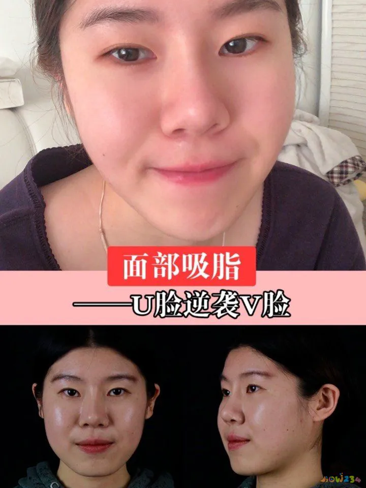 减肥瘦脸运动方法_减肥瘦脸能运动吗_运动减肥能瘦脸吗