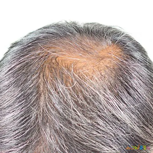 脱发做有氧运动_脱发运动_有氧运动 脱发