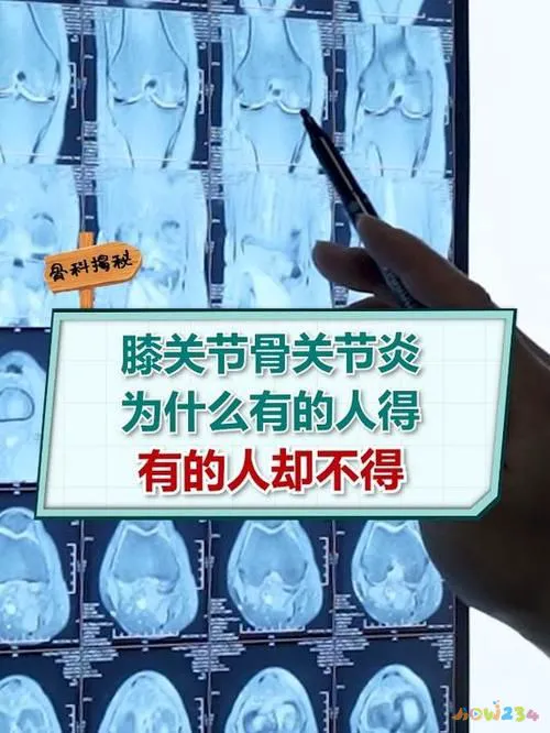 治疗剧烈运动后膝盖疼_膝盖剧烈运动后疼痛_运动后膝盖疼痛还能运动吗
