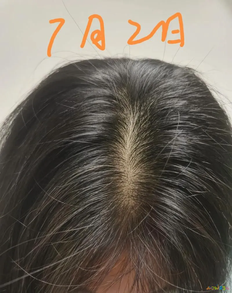 有氧运动 脱发_脱发做有氧运动_脱发无氧运动