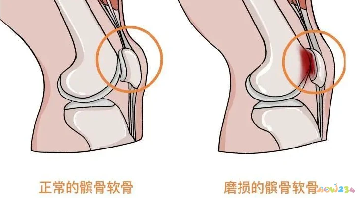 膝盖疼痛运动导致腿疼_运动导致的膝盖疼痛_膝盖疼痛运动导致疼痛