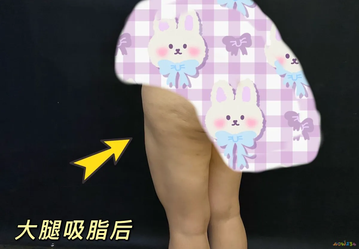 减肥做埋线会瘦吗_埋线减肥不运动胖_减肥埋线后可以剧烈运动吗