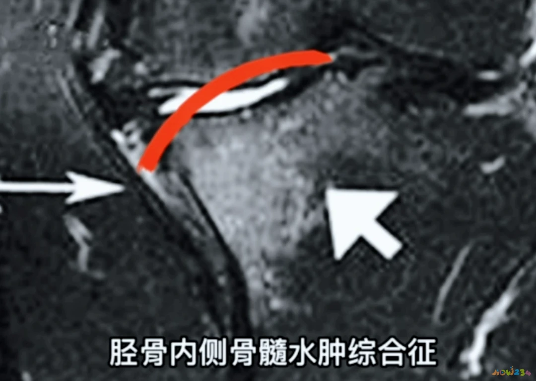 运动导致的膝盖疼痛_膝盖疼痛运动导致腿疼_膝盖疼痛运动导致疼痛