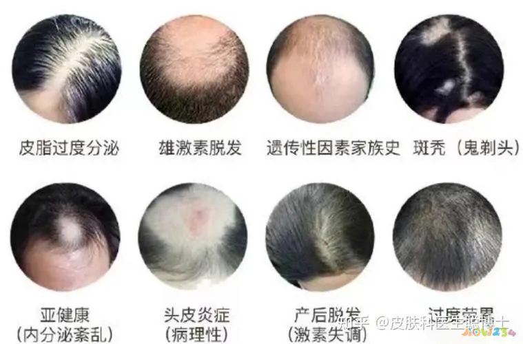 脱发运动_有氧运动 脱发_脱发无氧运动