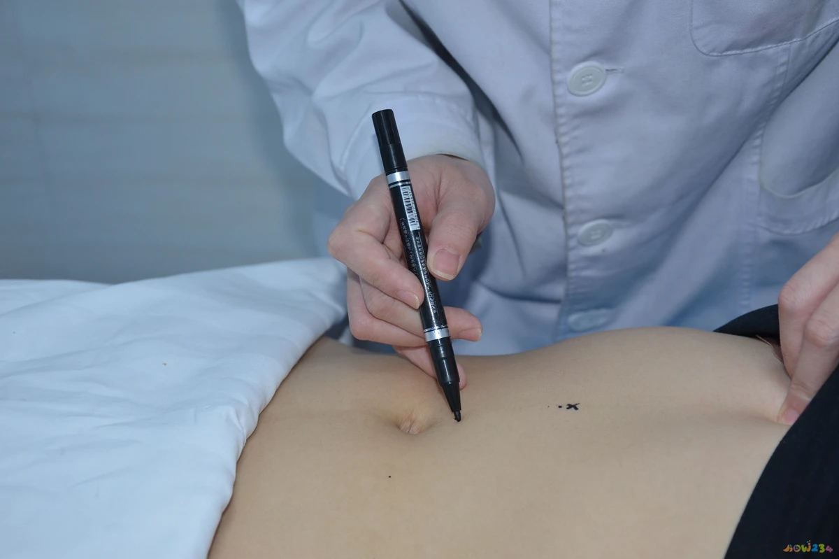 减肥埋线后可以剧烈运动吗_埋线减肥不运动胖_减肥做埋线会瘦吗