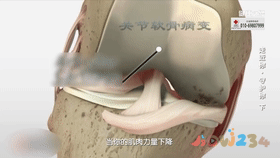 膝盖疼痛运动导致疼痛_膝盖疼剧烈运动_运动导致的膝盖疼痛