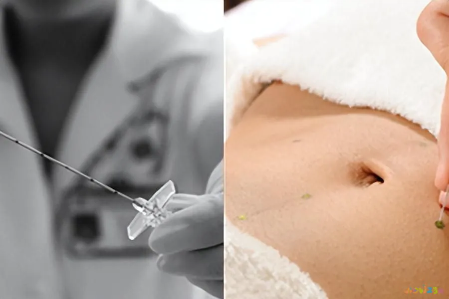 埋线减肥不运动胖_埋线加运动减肥_减肥埋线后可以剧烈运动吗