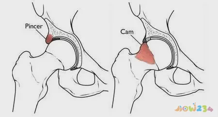 深蹲髋关节受伤_关节损伤运动深蹲髋关节疼_深蹲髋关节运动损伤