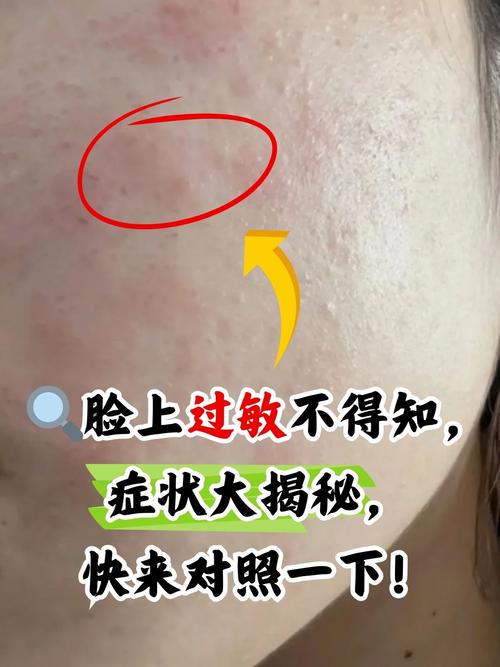 春季脸频过敏?换季护肤需警惕哪些诱因?