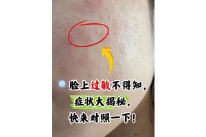 春季脸频过敏？换季护肤需警惕哪些诱因？