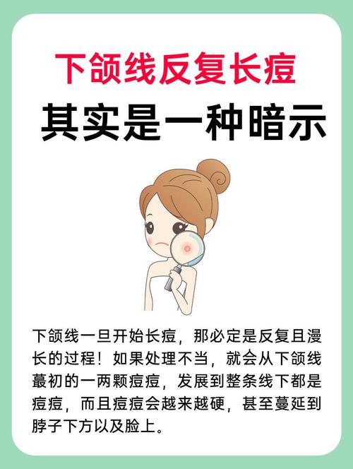 下颚痘痘频发,是内分泌还是护肤惹的祸?