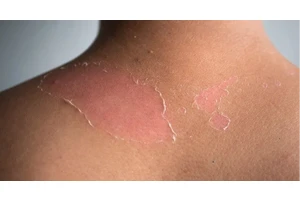 天一热，各路皮肤“刺客”来袭，怎么破局？