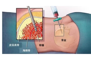【健康讲堂】“抽了骨髓要变傻？” —带您一起正确认识骨髓穿刺术