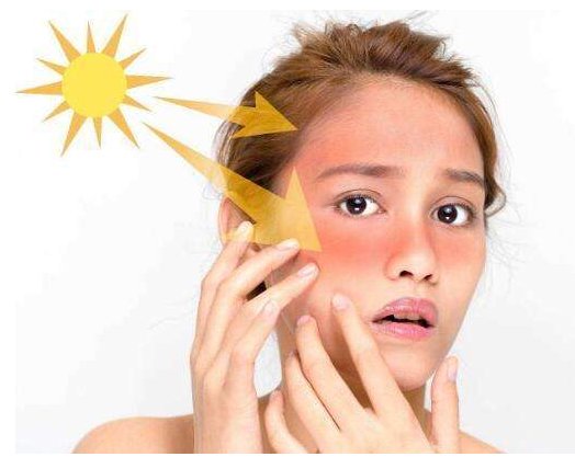 皮肤晒红了怎样快速美白 晒红 晒后美白 美妆 第1张