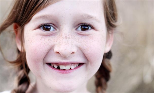 雀斑与黄褐斑的区别 雀斑 黄褐斑 第1张 雀斑与黄褐斑的区别 雀斑 黄褐斑 第1张