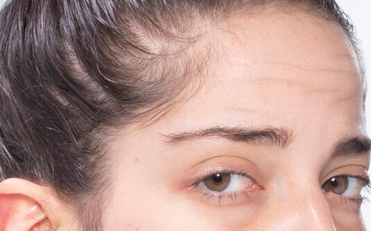 额头长抬头纹怎么办 抬头纹 改善抬头纹 美妆 第1张