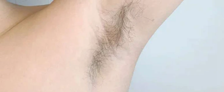 可以永久性脱毛吗 永久脱毛 美妆 第2张