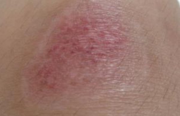 脱痂后红印可以擦粉底吗 粉底 脱痂化妆 美妆 第1张