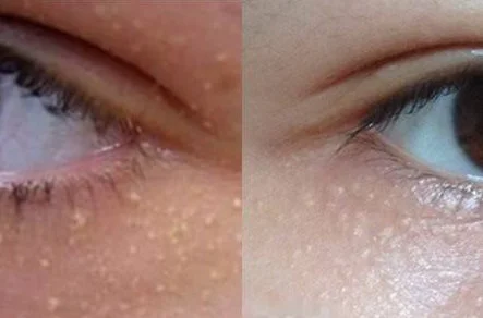 用护肤品起小米粒疙瘩怎么回事 过敏 小米粒疙瘩 美妆 第2张