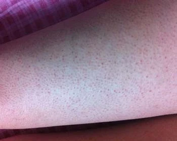 去除鸡皮肤的小知识教你轻松祛除鸡皮肤 鸡皮肤 美白祛黄 第2张