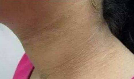 脖子黑怎么有效变白的方法 变白 脖子黑 美妆 第1张