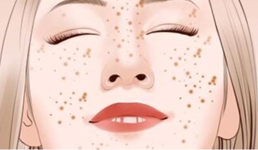 孕妇长雀斑怎么会遗传吗 雀斑 孕妇雀斑 美妆 第1张